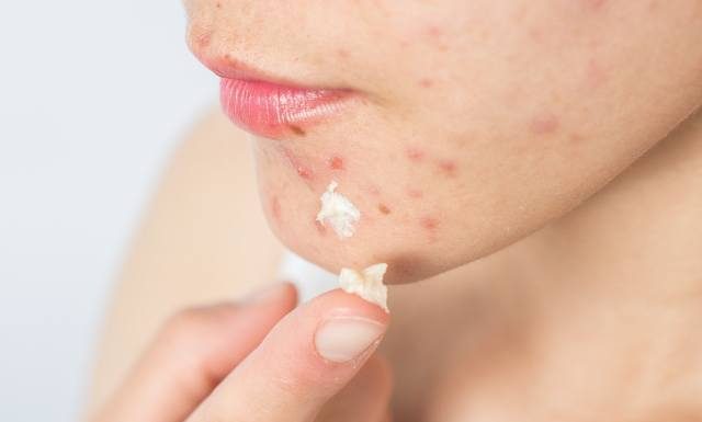 Rakotwórczy związek w kosmetykach na trądzik. Stosujesz ten składnik? W twojej łazience może być wysokie stężenie toksyny