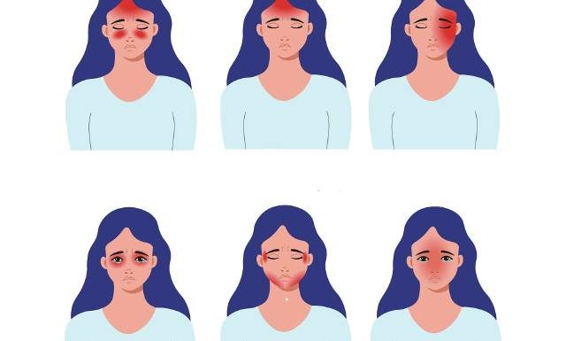 Mapa bólu głowy. Co oznacza ból głowy w danym miejscu? Naucz się rozpoznawać rodzaje bólu głowy po ich umiejscowieniu