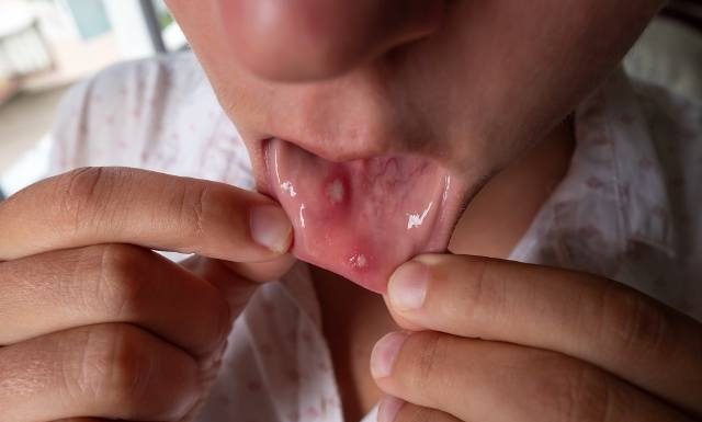 Powstają od urazów w jamie ustnej. Afty trzeba leczyć, zwłaszcza gdy nawracają. W niektórych przypadkach to może być opryszczka!