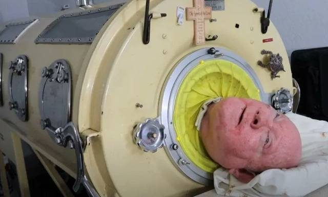 Paul Alexander nie żyje. Mężczyzna 70 lat żył w „żelaznych płucach”