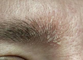 Takie zmiany na skórze to częsty zwiastun łuszczycy. Występują na głowie i twarzy, mogą spowodować wyłysienie! Zobacz, jak leczyć tę chorobę