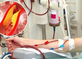 Żółty tłuszcz z żył zbiera się w workach. Innowacyjny zabieg oczyszcza krew ze złego cholesterolu. Przedłuża życie nawet o 10 lat