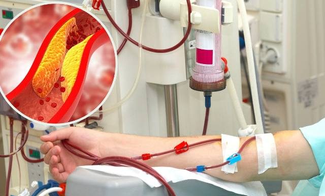 Żółty tłuszcz z żył zbiera się w workach. Innowacyjny zabieg oczyszcza krew ze złego cholesterolu. Przedłuża życie nawet o 10 lat