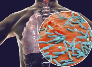 Objawia się nie tylko kaszlem. Gruźlica to realne zagrożenie. Jak ją rozpoznać i leczyć? Zobacz, co trzeba wiedzieć o gruźlicy