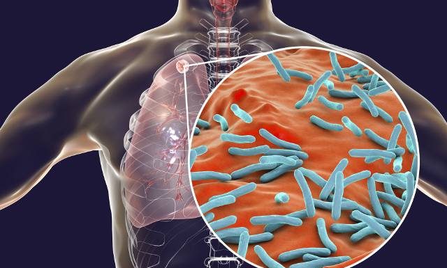 Objawia się nie tylko kaszlem. Gruźlica to realne zagrożenie. Jak ją rozpoznać i leczyć? Zobacz, co trzeba wiedzieć o gruźlicy