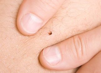 Nie rób tego, gdy ugryzie cię kleszcz. Te 5 błędów przy usuwaniu kleszcza grozi zakażeniem i rozwojem groźnych chorób. Sprawdź, czego unikać