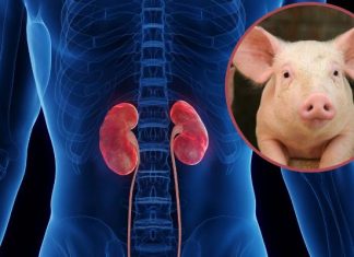 Mężczyzna z nerką od zmodyfikowanej genetycznie świni opuścił szpital. To pierwszy taki przeszczep na świecie