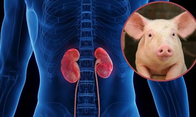 Mężczyzna z nerką od zmodyfikowanej genetycznie świni opuścił szpital. To pierwszy taki przeszczep na świecie