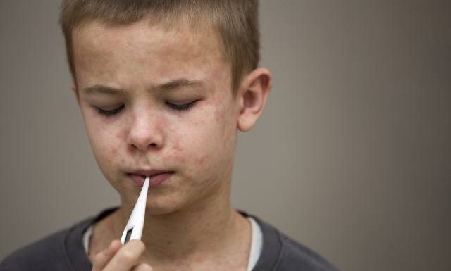 Sytuacja z odrą może wymknąć się spod kontroli? Gospodarz igrzysk olimpijskich ze wzrostem zakażeń