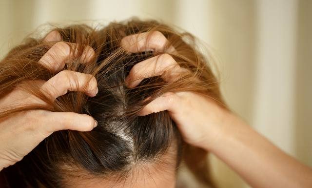 Swędzenie głowy to nie zawsze łupież, nawet gdy łuszczy się naskórek. To pomoże przy objawach problemów ze skórą głowy