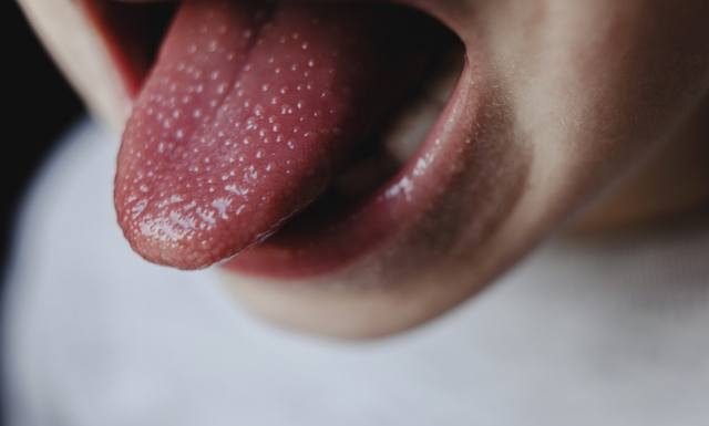 Alarmujące dane! 3,5 razy więcej zachorowań z bólem gardła i wysypką. To nie zwykła infekcja, ta choroba może skończyć się śmiercią