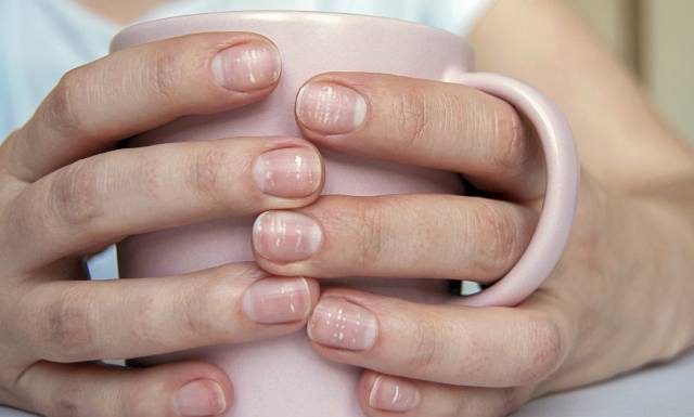 O czym świadczą białe plamy na paznokciach? Powody mogą cię zaskoczyć. Na liście m.in. manicure i leki