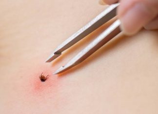 Kleszcz urwał ci się przy próbie wyjmowania? Wykonaj tę czynność jak najszybciej, a unikniesz zakażenia