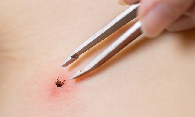 Kleszcz urwał ci się przy próbie wyjmowania? Wykonaj tę czynność jak najszybciej, a unikniesz zakażenia