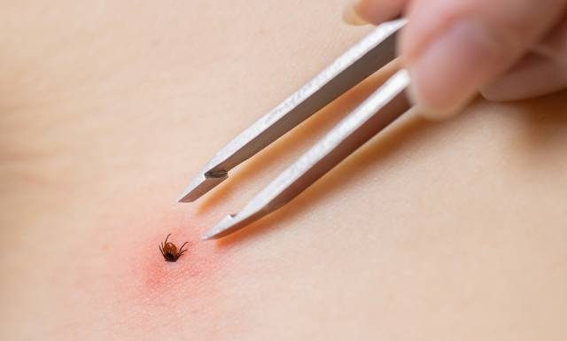 Kleszcz się urwał przy próbie wyjęcia go? Wykonaj tę czynność jak najszybciej. Unikniesz zakażenia