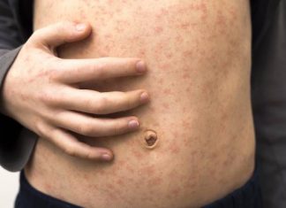 Zapomniany wirus powraca i atakuje z coraz większą siłą. Tendencja wzrostowa będzie się utrzymywać. Czy czeka nas kolejna epidemia?