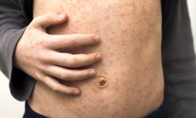 Zapomniany wirus powraca i atakuje z coraz większą siłą. Tendencja wzrostowa będzie się utrzymywać. Czy czeka nas kolejna epidemia?