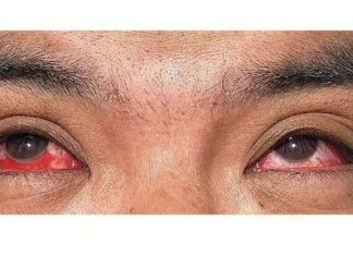 Pierwsze zdjęcie człowieka, który zaraził się w nietypowy sposób groźną chorobą