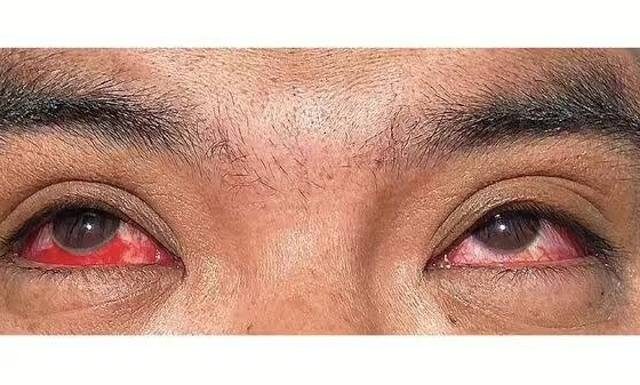 Pierwsze zdjęcie człowieka, który zaraził się w nietypowy sposób groźną chorobą