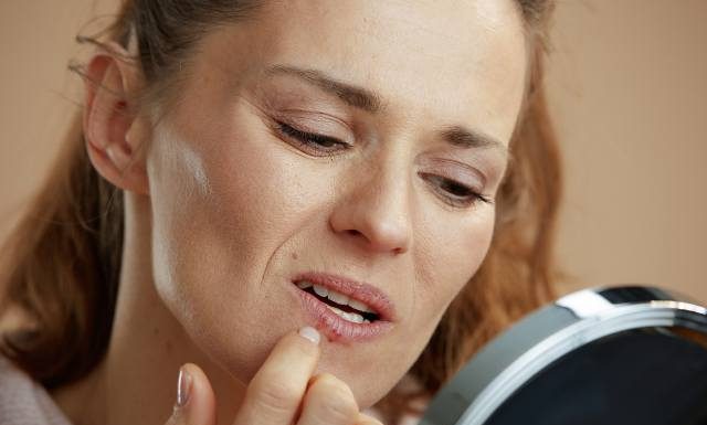 Dopadło cię „zimno”? Wypróbuj domowe sposoby na opryszczkę na ustach. W naturalny sposób zwalczą ból i inne objawy opryszczki wargowej