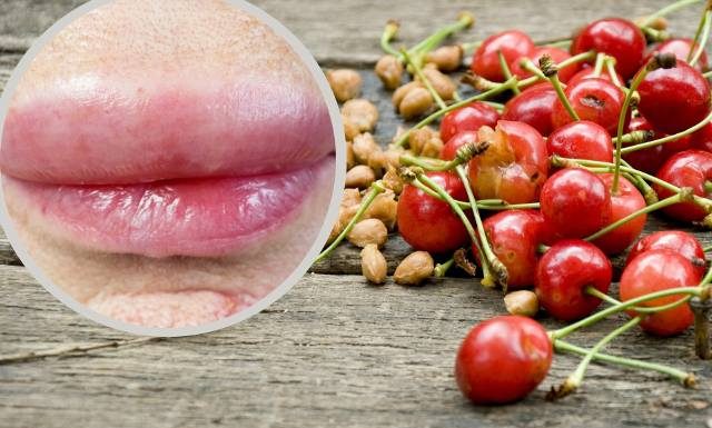 Zjadłam czereśnie i dostałam alergii. Nie zapomnę tego do końca życia. Najgorsze 30 minut, gdy nie wiedziałam, co robić