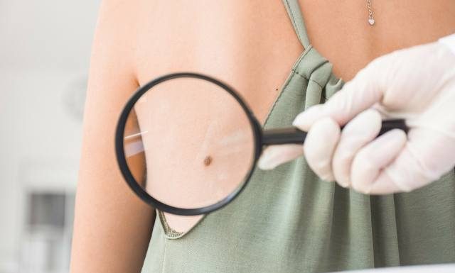 To już nie wyrok śmierci! Czerniaka można w 100 proc. wyleczyć, ale w tym celu trzeba go szybko wykryć. Onkolog apeluje o działanie