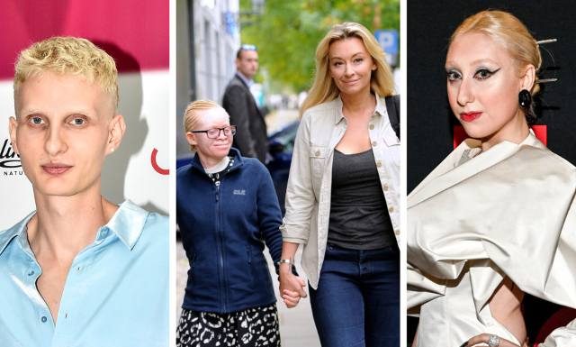 Albinosi są wrażliwi na promienie słoneczne. Tę cechę genetyczną ma m.in. Luna i córka Martyny Wojciechowskiej