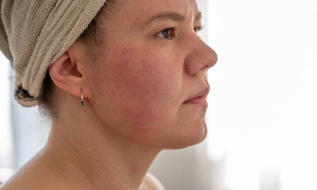Rozgrzana twarz? Jeśli czerwone są jej pewne obszary, to bardzo zły znak. Może sygnalizować poważne choroby i szybkie starzenie się