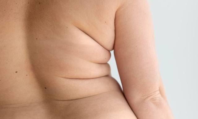 Tkanka tłuszczowa w tym miejscu najbardziej sprzyja demencji. Najwyższe ryzyko rozwoju alzheimera i parkinsona to wcale nie duży brzuch