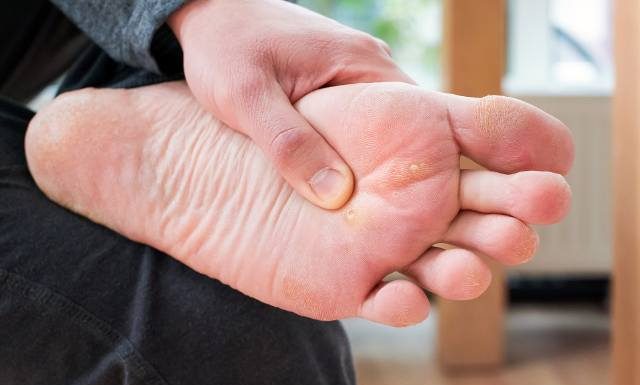 Boli, zaraża i długo nie znika… Jak pozbyć się kurzajki na stopie? Poznaj sposoby usuwania kurzajek