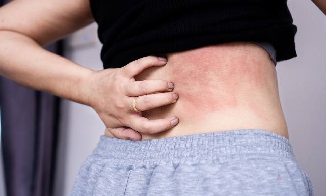 Te krostki to potówki. Powstają nawet u noworodków. Wyjaśniamy, kiedy takie zmiany skórne są groźne i co z nimi robić