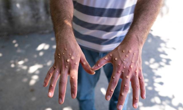 Nowa śmiercionośna odmiana małpiej ospy wykryta w Europie. Groźny wirus rozprzestrzenia się błyskawicznie i zabija głównie dzieci