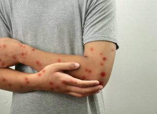 Czy grozi nam epidemia małpiej ospy? Unijna agencja przestrzega przed wzrostem zakażeń. Epidemiolog uspokaja: ryzyko dla Europy jest nieduże