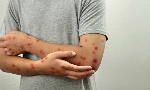 Czy grozi nam epidemia małpiej ospy? Unijna agencja przestrzega przed wzrostem zakażeń. Epidemiolog uspokaja: ryzyko dla Europy jest nieduże
