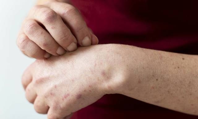 Taka wysypka to ospa czy może bostonka? Występuje nie tylko u dzieci. Sprawdź, jakie są objawy wysypki bostońskiej i czy jest groźna w ciąży