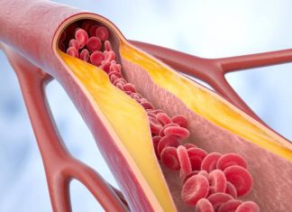 Miażdżyca – cichy wróg zdrowia. Czym jest miażdżyca, jak się rozwija i jakie są metody leczenia? Poznaj objawy miażdżycy