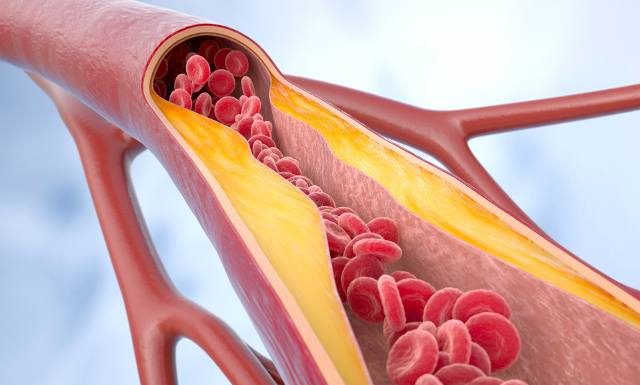 Miażdżyca – cichy wróg zdrowia. Czym jest miażdżyca, jak się rozwija i jakie są metody leczenia? Poznaj objawy miażdżycy