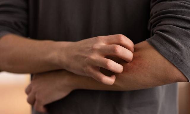 Swędzenie skóry – niewinne podrażnienie czy sygnał poważnych problemów zdrowotnych? Dowiedz się, co może być przyczyną świądu skóry