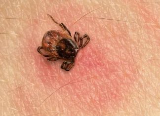 Ugryzł cię kleszcz? Nie rób tego! Tych 5 błędów przy usuwaniu kleszcza grozi zakażeniem i rozwojem groźnych chorób. Sprawdź, czego unikać