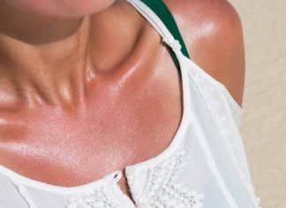 Co pomoże na oparzenie słoneczne? Zobacz najlepsze domowe sposoby na czerwoną skórę, pieczenie, ból i bąble po opalaniu