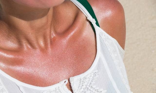 Co pomoże na oparzenie słoneczne? Zobacz najlepsze domowe sposoby na czerwoną skórę, pieczenie, ból i bąble po opalaniu