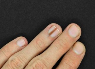 Czerniak paznokcia – objawy, przyczyny, leczenie i rokowanie. Sprawdź, czy czarne kreski pod paznokciem zawsze świadczą o czerniaku?