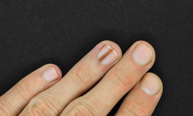 Czerniak paznokcia – objawy, przyczyny, leczenie i rokowanie. Sprawdź, czy czarne kreski pod paznokciem zawsze świadczą o czerniaku?