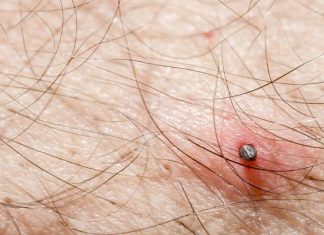 Rumień po kleszczu – alergia czy borelioza? Sprawdź, kiedy zaczerwienienie powinno niepokoić