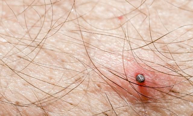 Rumień po kleszczu – alergia czy borelioza? Sprawdź, kiedy zaczerwienienie powinno niepokoić
