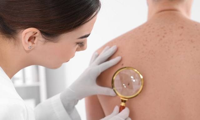 Czerniak, czyli złośliwy nowotwór skóry. Przyczyny, objawy i leczenie. Czerniak a pieprzyk – jak odróżnić?
