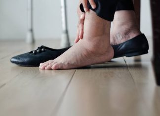 Objawy dny moczanowej możesz łatwo pomylić z przemęczeniem lub innym schorzeniem. Nie ignoruj ich! Mogą być powiązane z podagrą