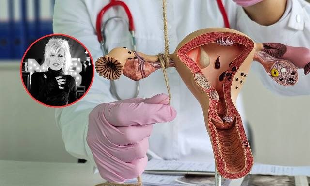 Kora latami żyła z bólem. Diagnoza przyszła za późno. To jeden z najgroźniejszych nowotworów u kobiet