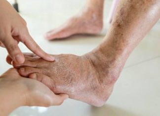 Objawy choroby Alzheimera widoczne na stopach. Po tych zmianach poznasz, że rozwija się demencja