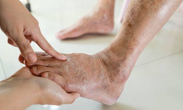 Objawy choroby Alzheimera widoczne na stopach. Po tych zmianach poznasz, że rozwija się demencja